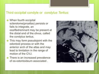 Third occipital condyle or condylus Tertius:
 When fourth occipital
sclerotome(proatlas) persists or
fails to integrate, an
ossifledremnant may be present at
the distal end of the clivus, called
the condylus tertius.
 This may form pseudojoint with the
odontoid process or with the
anterior arch of the atlas and may
lead to limitation in the range of
motion of the CVJ.
 There is an increased prevalence
of os-odontoideum associated .
 