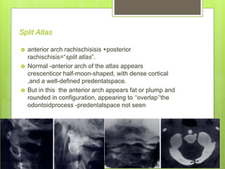 Split Atlas
 anterior arch rachischisisis +posterior
rachischisis=“split atlas”.
 Normal -anterior arch of the atlas appears
crescenticor half-moon-shaped, with dense cortical
,and a well-defined predentalspace.
 But in this the anterior arch appears fat or plump and
rounded in configuration, appearing to ‘‘overlap’‘the
odontoidprocess -predentalspace not seen
 