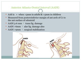 craniovertebral junction anomalies rjj.pptx