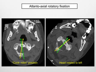 Instability of the cranio-vertebral junction (CVJ) | PPTX