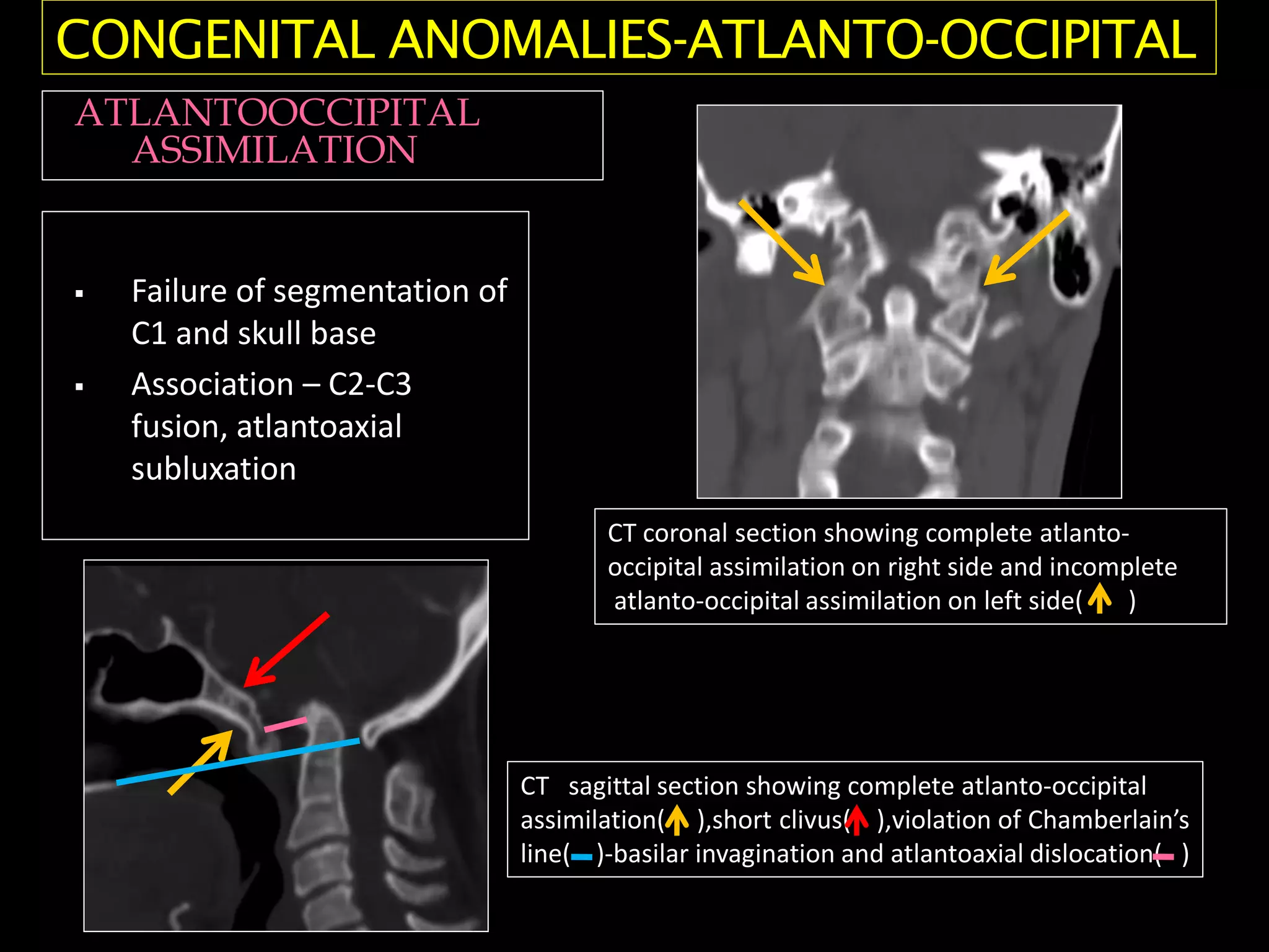 Failure of segmentation of
C1 and skull base
 Association – C2-C3
fusion, atlantoaxial
subluxation
CT coronal section showing complete atlanto-
occipital assimilation on right side and incomplete
atlanto-occipital assimilation on left side( )
CONGENITAL ANOMALIES-ATLANTO-OCCIPITAL
ATLANTOOCCIPITAL
ASSIMILATION
CT sagittal section showing complete atlanto-occipital
assimilation( ),short clivus( ),violation of Chamberlain’s
line( )-basilar invagination and atlantoaxial dislocation( )
 