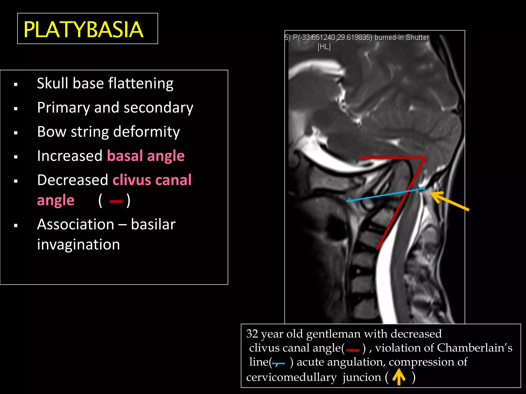  Skull base flattening
 Primary and secondary
 Bow string deformity
 Increased basal angle
 Decreased clivus canal
angle ( )
 Association – basilar
invagination
32 year old gentleman with decreased
clivus canal angle( ) , violation of Chamberlain’s
line( , ) acute angulation, compression of
cervicomedullary juncion ( )
PLATYBASIA
 