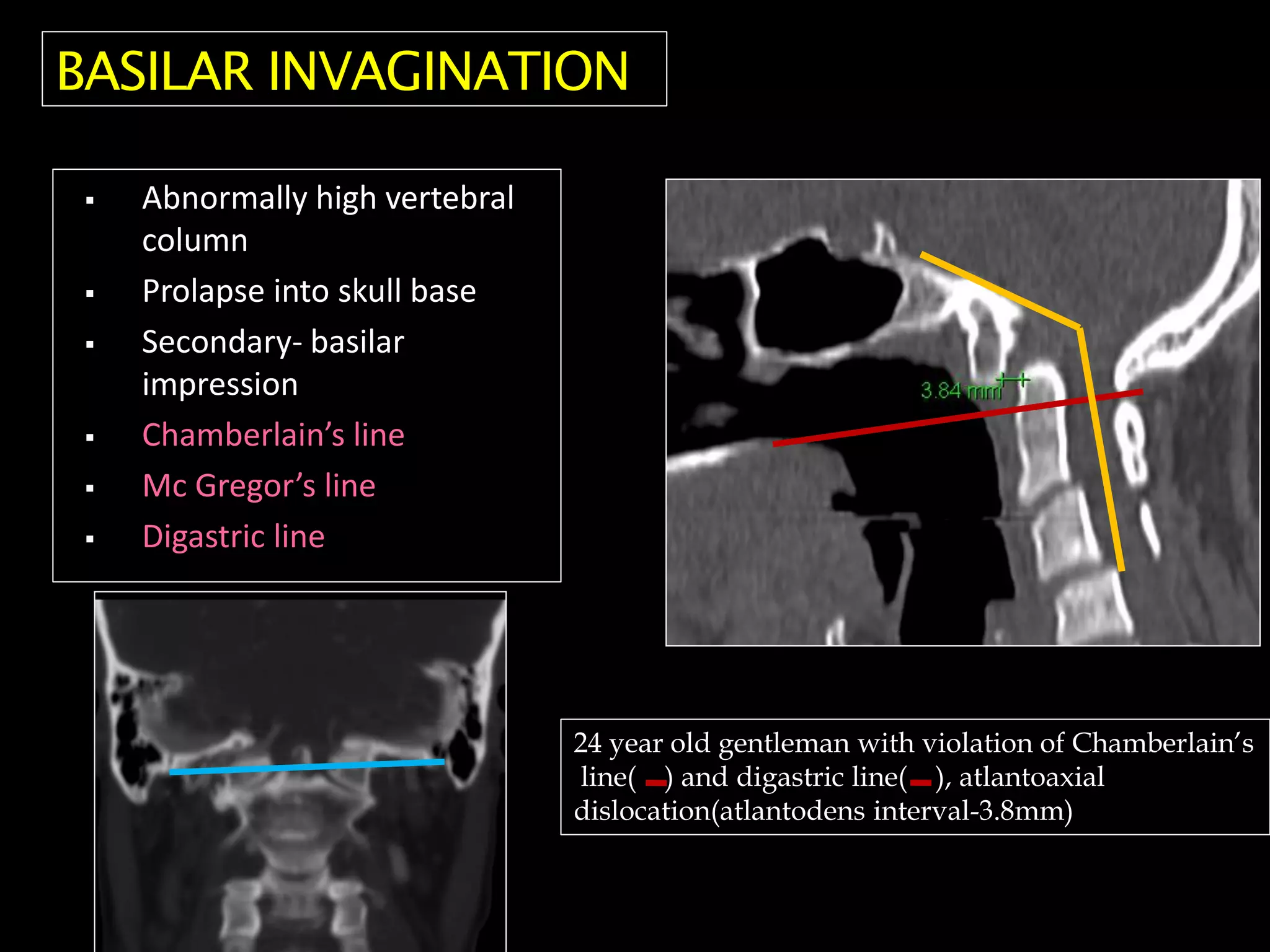  Abnormally high vertebral
column
 Prolapse into skull base
 Secondary- basilar
impression
 Chamberlain’s line
 Mc Gregor’s line
 Digastric line
24 year old gentleman with violation of Chamberlain’s
line( ) and digastric line( ), atlantoaxial
dislocation(atlantodens interval-3.8mm)
BASILAR INVAGINATION
 