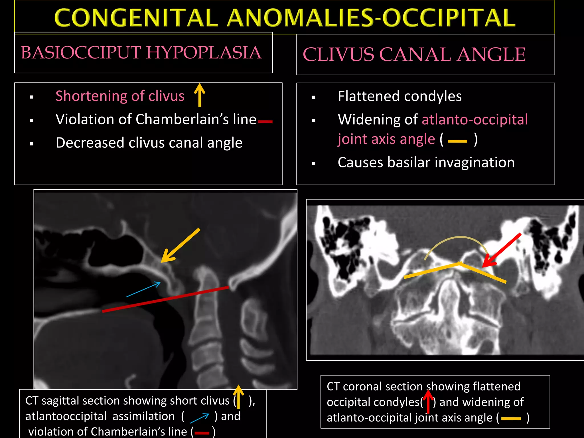 BASIOCCIPUT HYPOPLASIA CLIVUS CANAL ANGLE
 Shortening of clivus
 Violation of Chamberlain’s line
 Decreased clivus canal angle
 Flattened condyles
 Widening of atlanto-occipital
joint axis angle ( )
 Causes basilar invagination
CT sagittal section showing short clivus ( ),
atlantooccipital assimilation ( ) and
violation of Chamberlain’s line ( )
CT coronal section showing flattened
occipital condyles( ) and widening of
atlanto-occipital joint axis angle ( )
 