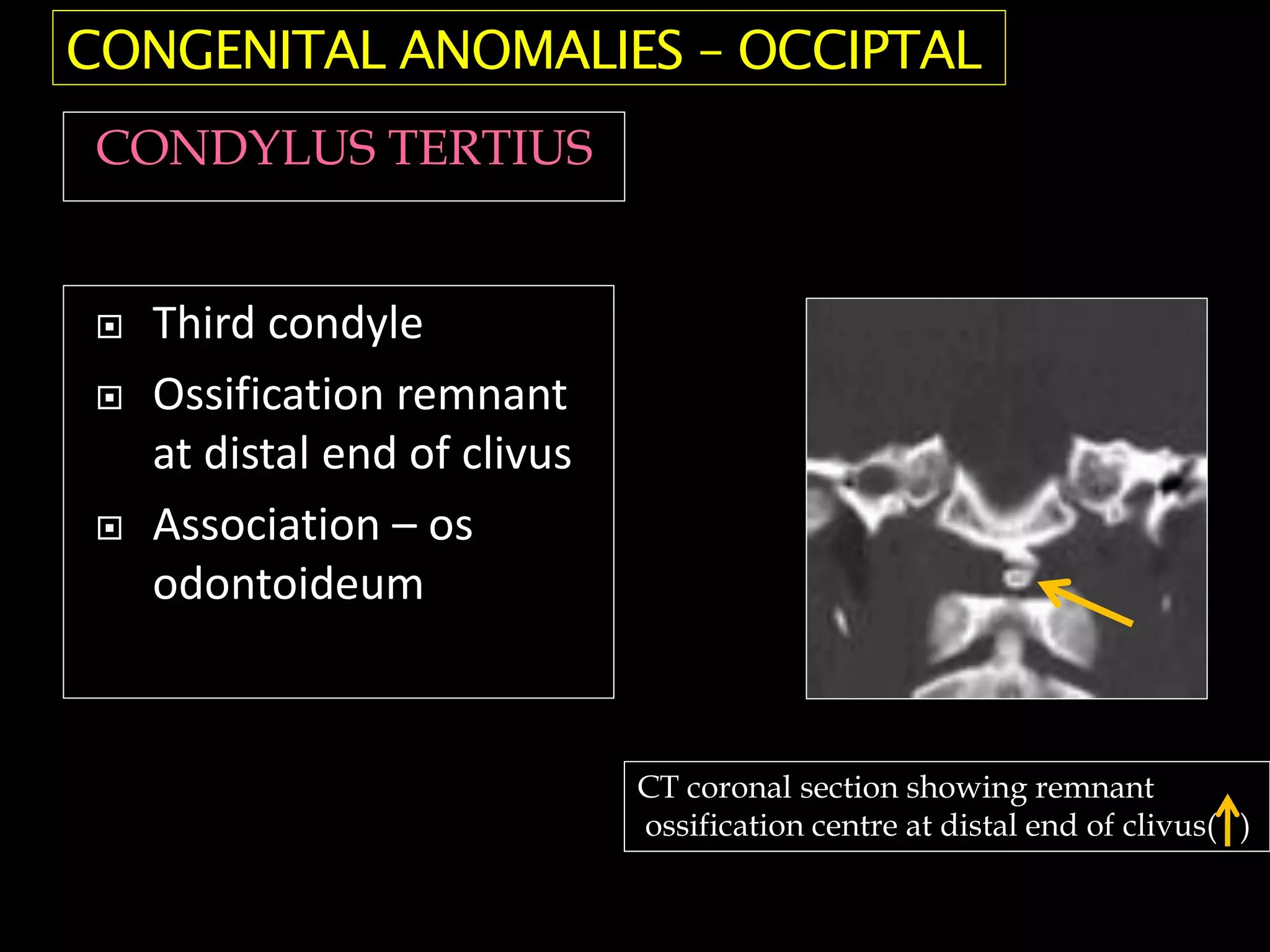  Third condyle
 Ossification remnant
at distal end of clivus
 Association – os
odontoideum
CT coronal section showing remnant
ossification centre at distal end of clivus( )
CONGENITAL ANOMALIES – OCCIPTAL
CONDYLUS TERTIUS
 