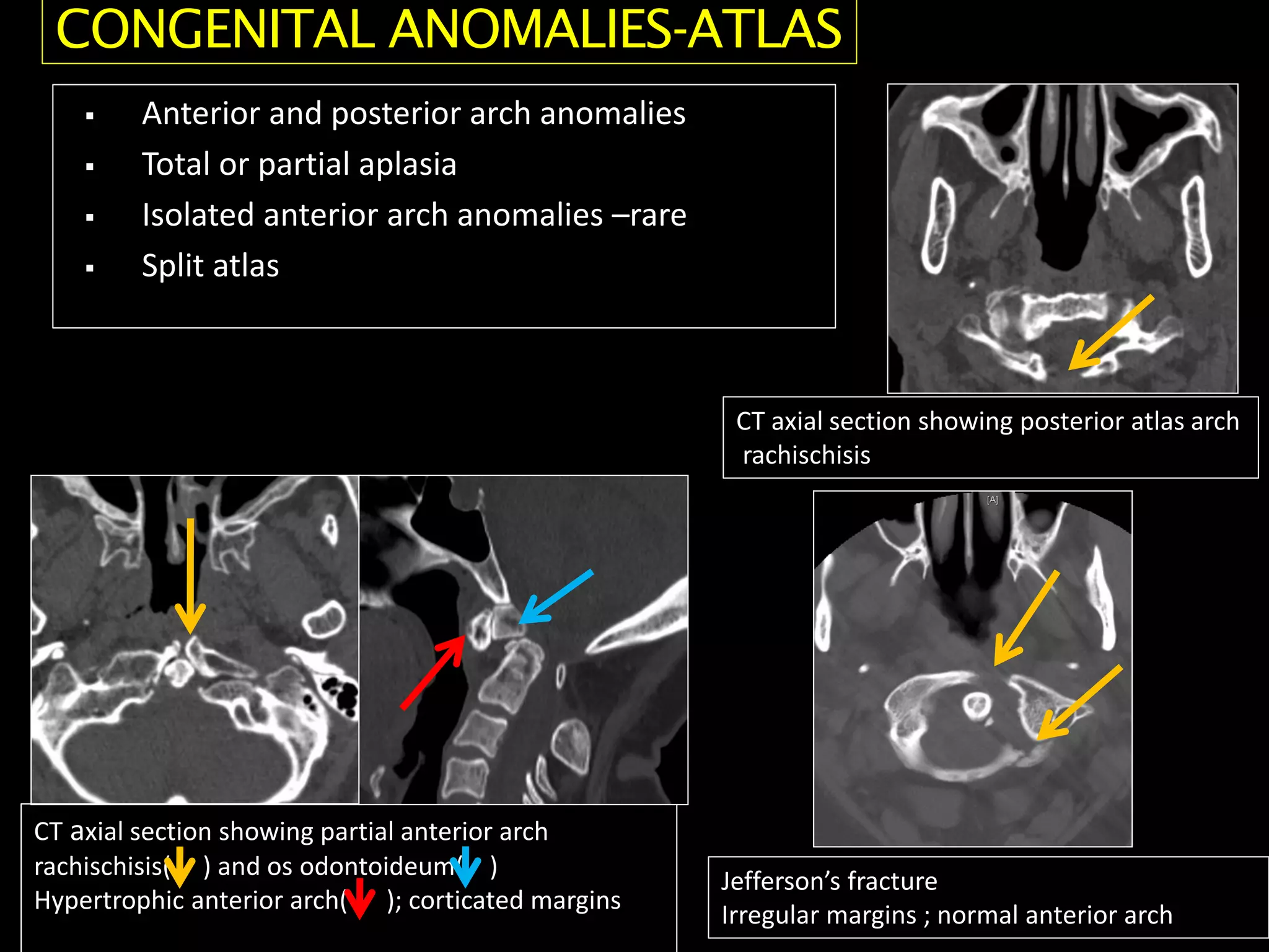  Anterior and posterior arch anomalies
 Total or partial aplasia
 Isolated anterior arch anomalies –rare
 Split atlas
CT axial section showing posterior atlas arch
rachischisis
CT axial section showing partial anterior arch
rachischisis( ) and os odontoideum( )
Hypertrophic anterior arch( ); corticated margins
Jefferson’s fracture
Irregular margins ; normal anterior arch
CONGENITAL ANOMALIES-ATLAS
 