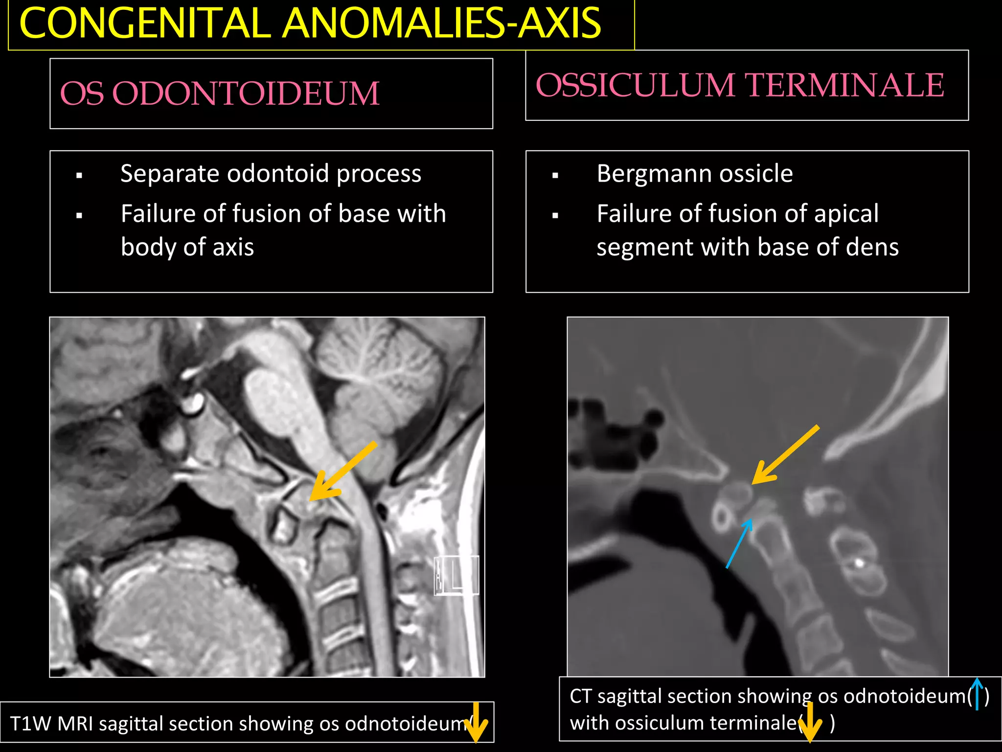 OS ODONTOIDEUM OSSICULUM TERMINALE
 Separate odontoid process
 Failure of fusion of base with
body of axis
 Bergmann ossicle
 Failure of fusion of apical
segment with base of dens
CONGENITAL ANOMALIES-AXIS
T1W MRI sagittal section showing os odnotoideum(
CT sagittal section showing os odnotoideum( )
with ossiculum terminale( )
 