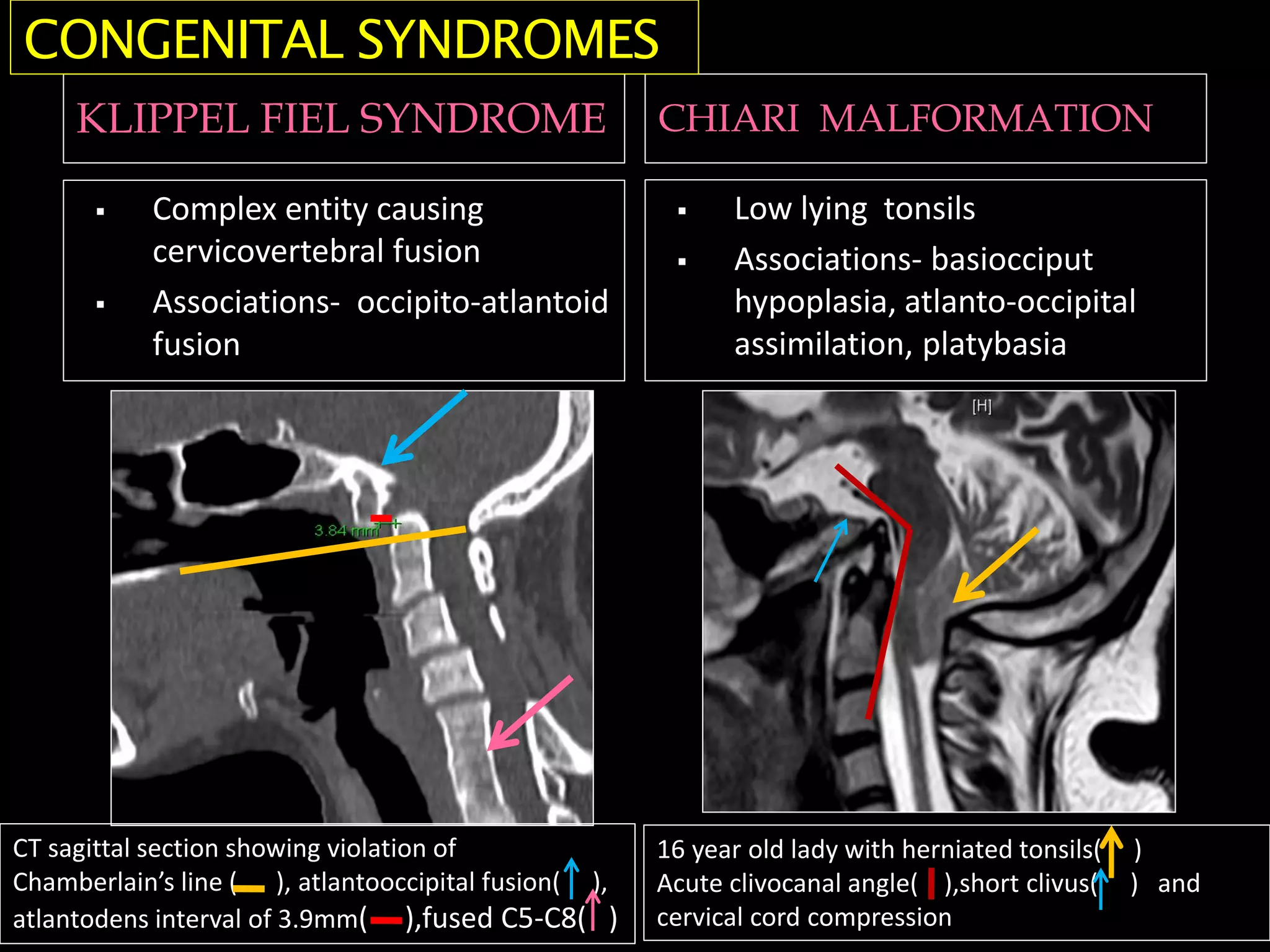 KLIPPEL FIEL SYNDROME CHIARI MALFORMATION
 Complex entity causing
cervicovertebral fusion
 Associations- occipito-atlantoid
fusion
 Low lying tonsils
 Associations- basiocciput
hypoplasia, atlanto-occipital
assimilation, platybasia
CONGENITAL SYNDROMES
16 year old lady with herniated tonsils( )
Acute clivocanal angle( ),short clivus( ) and
cervical cord compression
CT sagittal section showing violation of
Chamberlain’s line ( ), atlantooccipital fusion( ),
atlantodens interval of 3.9mm( ),fused C5-C8( )
 