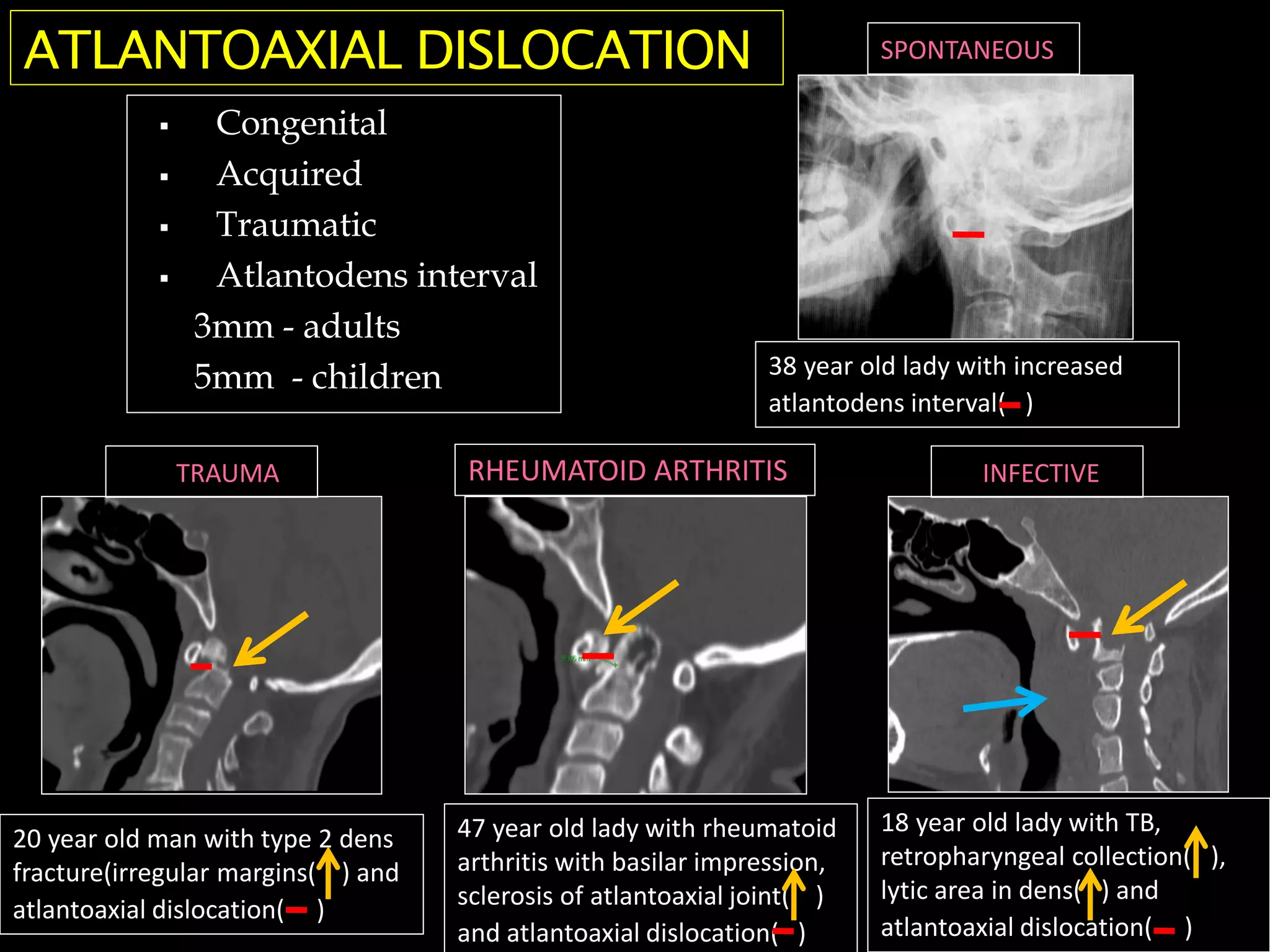  Congenital
 Acquired
 Traumatic
 Atlantodens interval
3mm - adults
5mm - children
ATLANTOAXIAL DISLOCATION
20 year old man with type 2 dens
fracture(irregular margins( ) and
atlantoaxial dislocation( )
47 year old lady with rheumatoid
arthritis with basilar impression,
sclerosis of atlantoaxial joint( )
and atlantoaxial dislocation( )
18 year old lady with TB,
retropharyngeal collection( ),
lytic area in dens( ) and
atlantoaxial dislocation( )
38 year old lady with increased
atlantodens interval( )
SPONTANEOUS
INFECTIVE
RHEUMATOID ARTHRITIS
TRAUMA
 