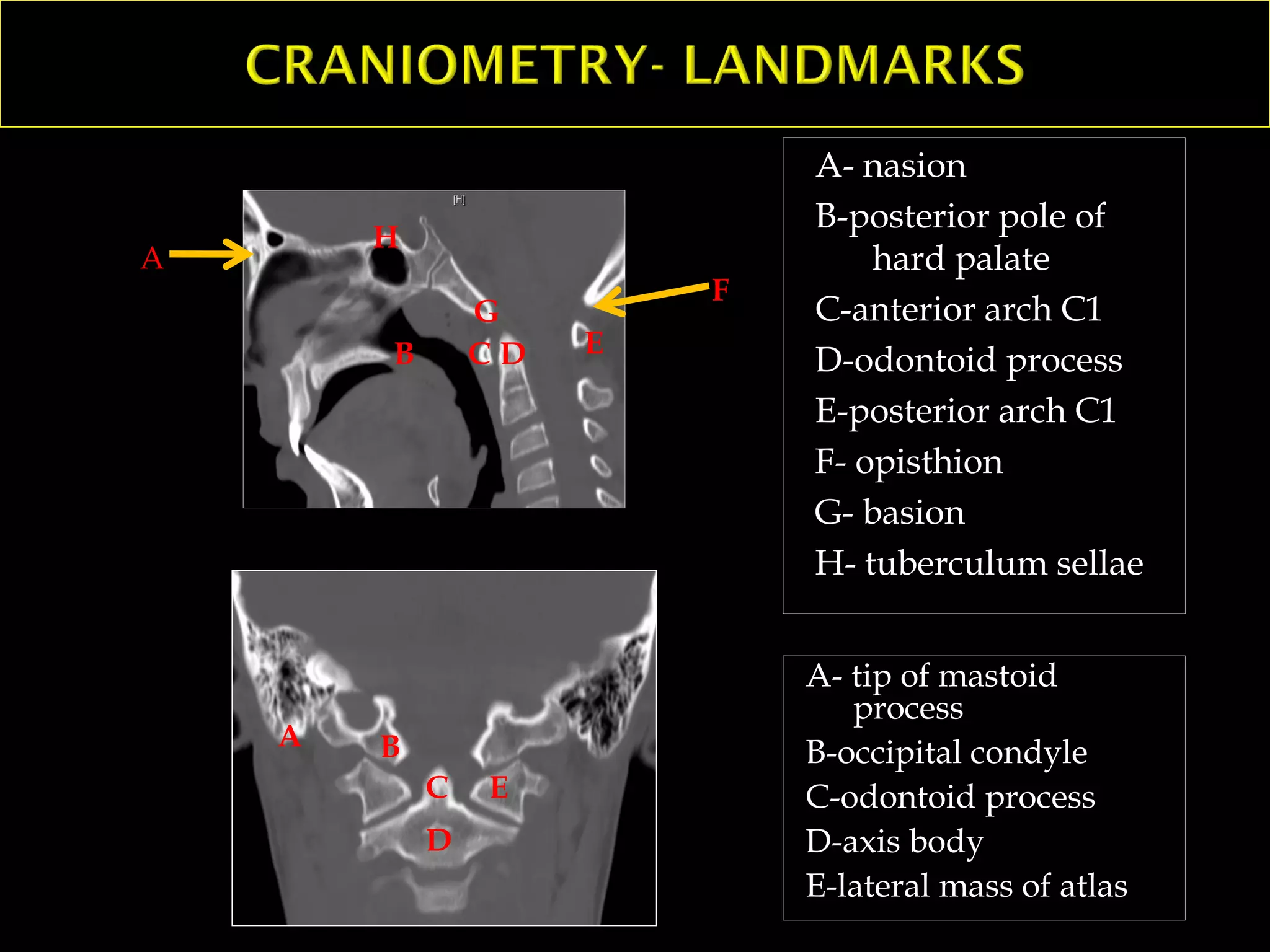 A- nasion
B-posterior pole of
hard palate
C-anterior arch C1
D-odontoid process
E-posterior arch C1
F- opisthion
G- basion
H- tuberculum sellae
A
B
C D E
F
G
H
A
B
C
D
E
A- tip of mastoid
process
B-occipital condyle
C-odontoid process
D-axis body
E-lateral mass of atlas
 