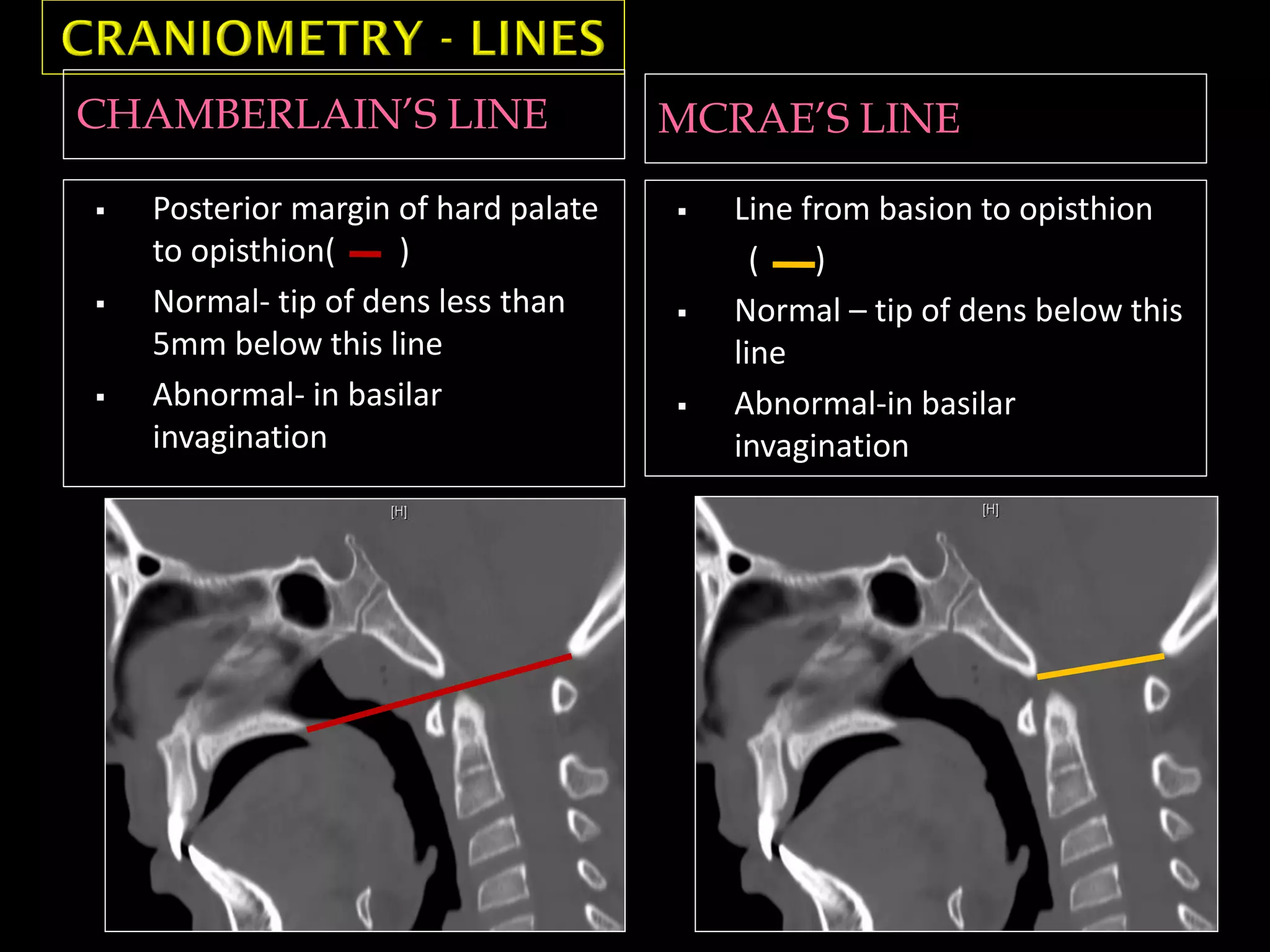 CHAMBERLAIN’S LINE MCRAE’S LINE
 Posterior margin of hard palate
to opisthion( )
 Normal- tip of dens less than
5mm below this line
 Abnormal- in basilar
invagination
 Line from basion to opisthion
( )
 Normal – tip of dens below this
line
 Abnormal-in basilar
invagination
 