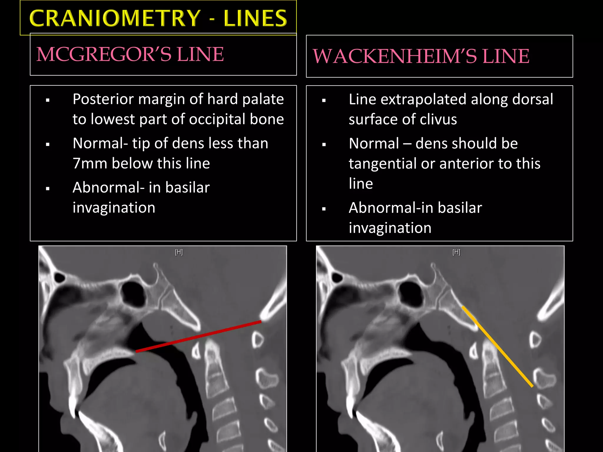 MCGREGOR’S LINE WACKENHEIM’S LINE
 Posterior margin of hard palate
to lowest part of occipital bone
 Normal- tip of dens less than
7mm below this line
 Abnormal- in basilar
invagination
 Line extrapolated along dorsal
surface of clivus
 Normal – dens should be
tangential or anterior to this
line
 Abnormal-in basilar
invagination
 
