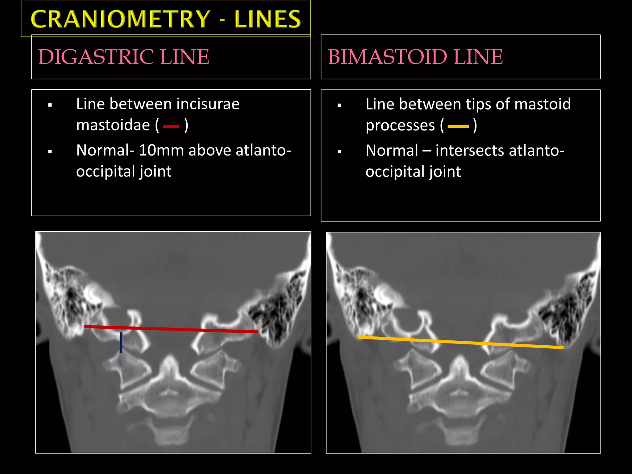 DIGASTRIC LINE BIMASTOID LINE
 Line between incisurae
mastoidae ( )
 Normal- 10mm above atlanto-
occipital joint
 Line between tips of mastoid
processes ( )
 Normal – intersects atlanto-
occipital joint
 