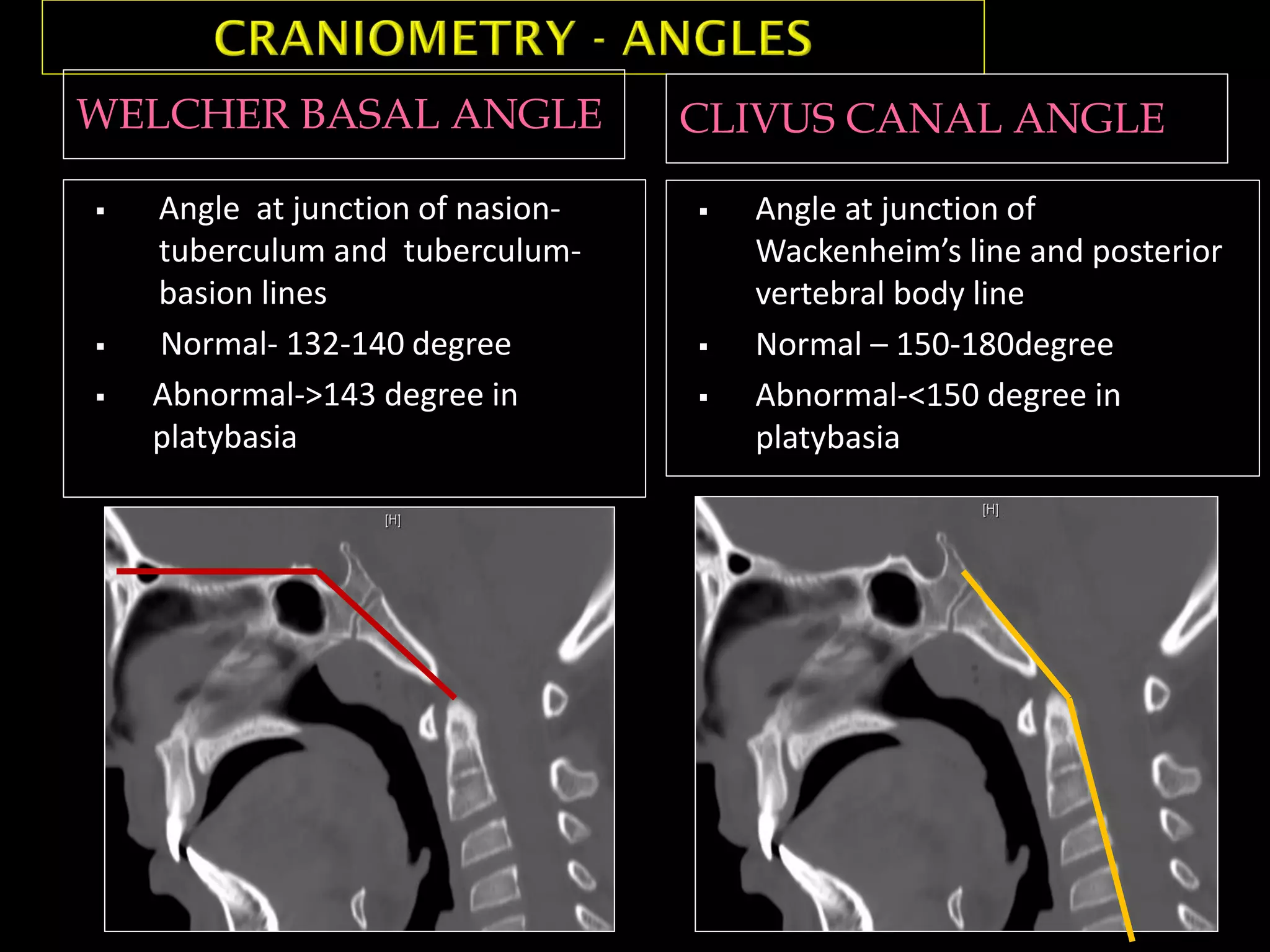 WELCHER BASAL ANGLE CLIVUS CANAL ANGLE
 Angle at junction of nasion-
tuberculum and tuberculum-
basion lines
 Normal- 132-140 degree
 Abnormal->143 degree in
platybasia
 Angle at junction of
Wackenheim’s line and posterior
vertebral body line
 Normal – 150-180degree
 Abnormal-<150 degree in
platybasia
 