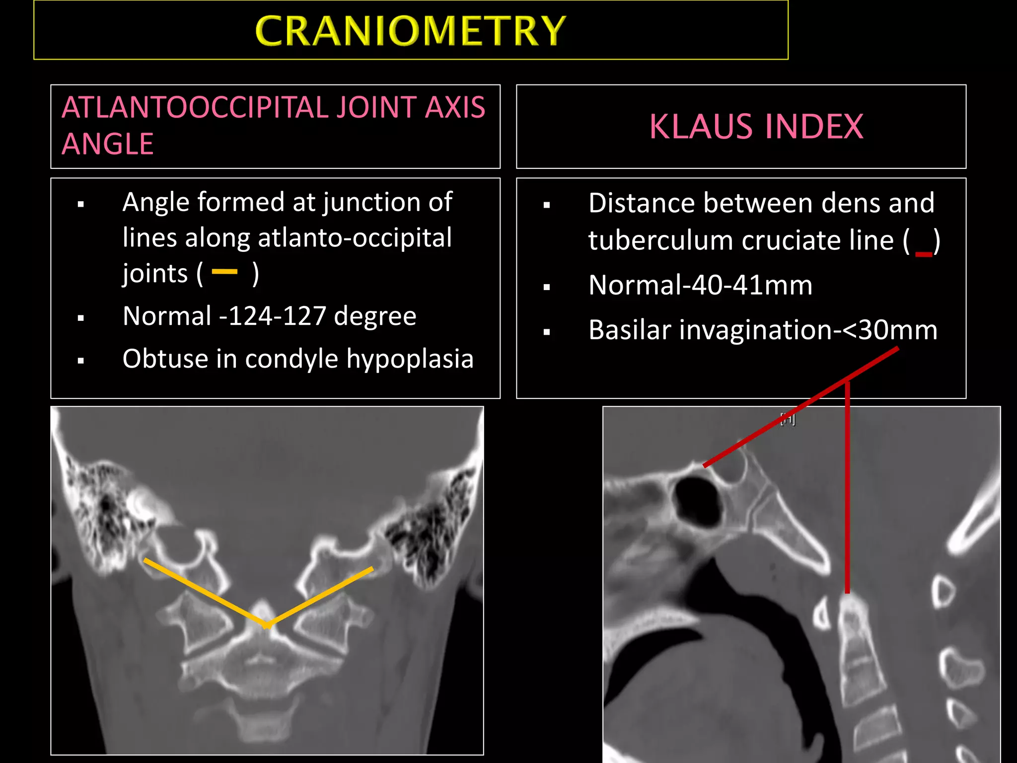 ATLANTOOCCIPITAL JOINT AXIS
ANGLE KLAUS INDEX
 Angle formed at junction of
lines along atlanto-occipital
joints ( )
 Normal -124-127 degree
 Obtuse in condyle hypoplasia
 Distance between dens and
tuberculum cruciate line ( )
 Normal-40-41mm
 Basilar invagination-<30mm
 
