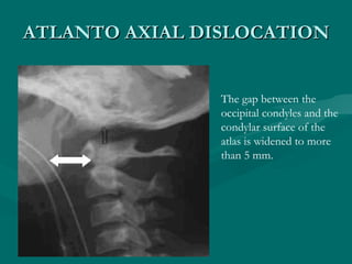 ATLANTO AXIAL DISLOCATION The gap between the occipital condyles and the condylar surface of the atlas is widened to more ...