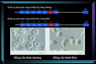 Hồng cầu bình thường Hồng cầu hình liềm
Val His Leu Thr Pro Glu Glu
7 146
1
Val
2
His
3
Leu
4
Thr
5
Pro
6
Val
7
Glu
146
Trình tự acid amin trong chuỗi bêta bình thường
1 2 3 4 5 6
Trình tự acid amin trong chuỗi bêta trong HbS
 