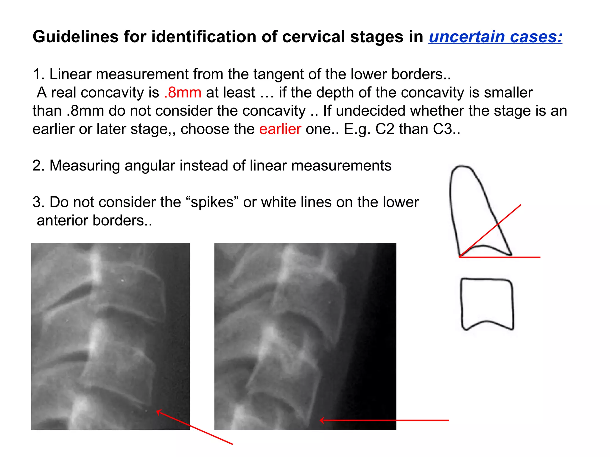 Guidelines for identification of cervical stages in  uncertain cases: 1. Linear measurement from the tangent of the lower borders.. A real concavity is  .8mm  at least … if the depth of the concavity is smaller than .8mm do not consider the concavity .. If undecided whether the stage is an earlier or later stage,, choose the  earlier  one.. E.g. C2 than C3.. 2. Measuring angular instead of linear measurements 3. Do not consider the “spikes” or white lines on the lower anterior borders.. 