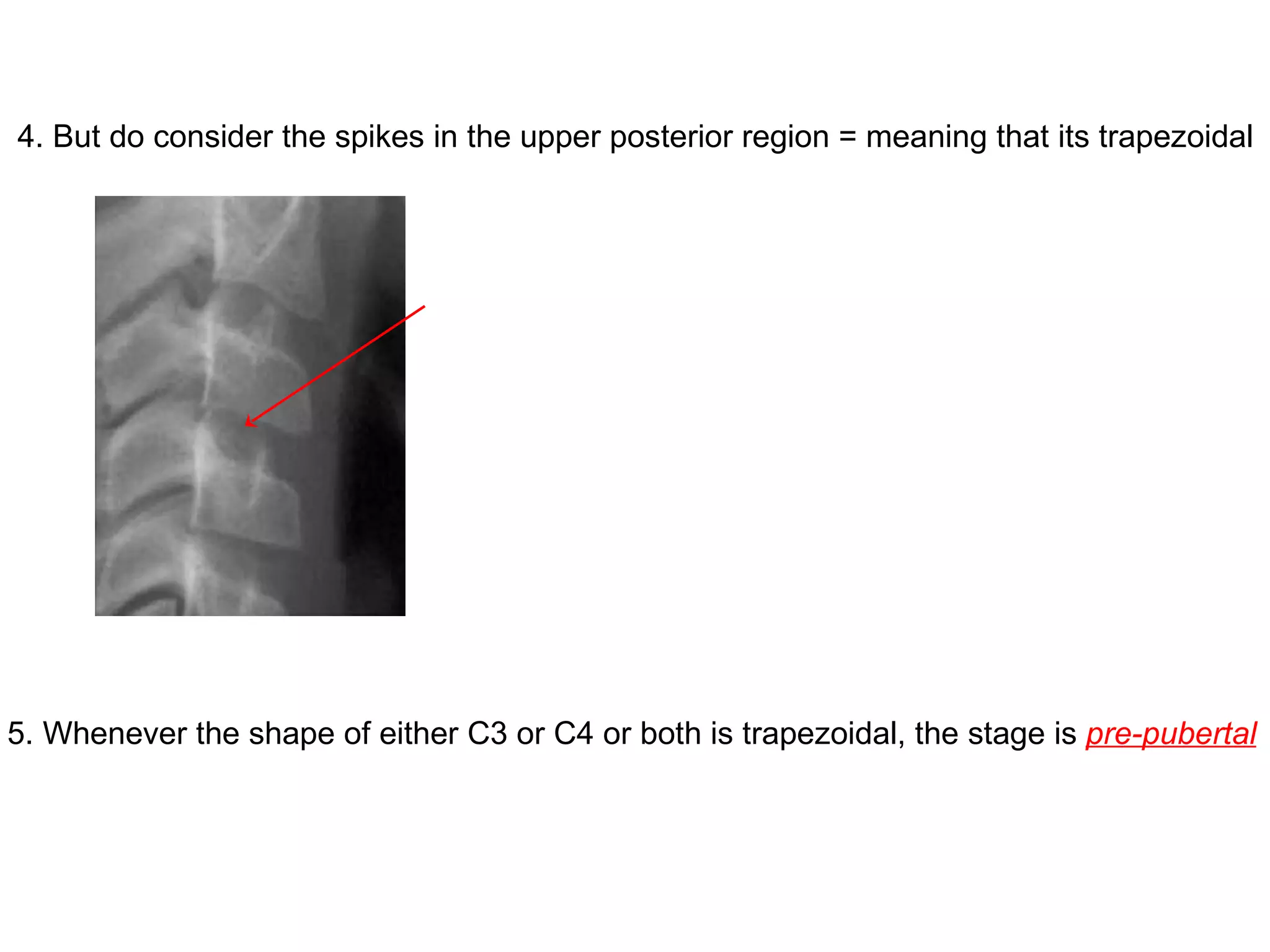 4. But do consider the spikes in the upper posterior region = meaning that its trapezoidal 5. Whenever the shape of either C3 or C4 or both is trapezoidal, the stage is  pre-pubertal 