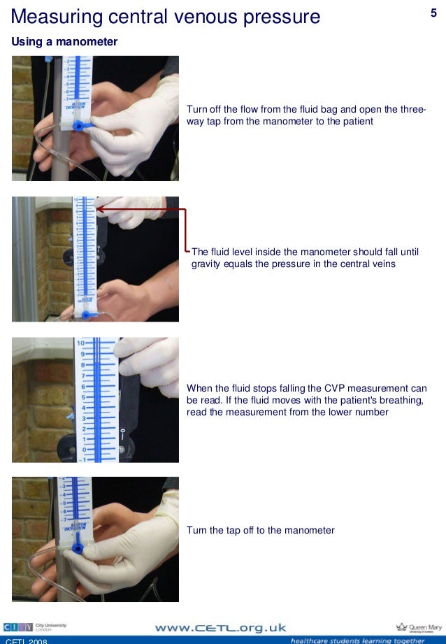 central venous pressure