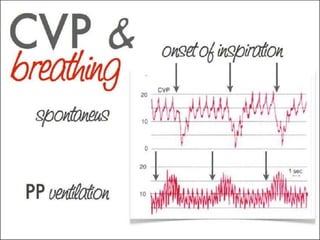 CVP Monitoring_Dr. Subrata Kumar_BSMMU_2014 | PPTX