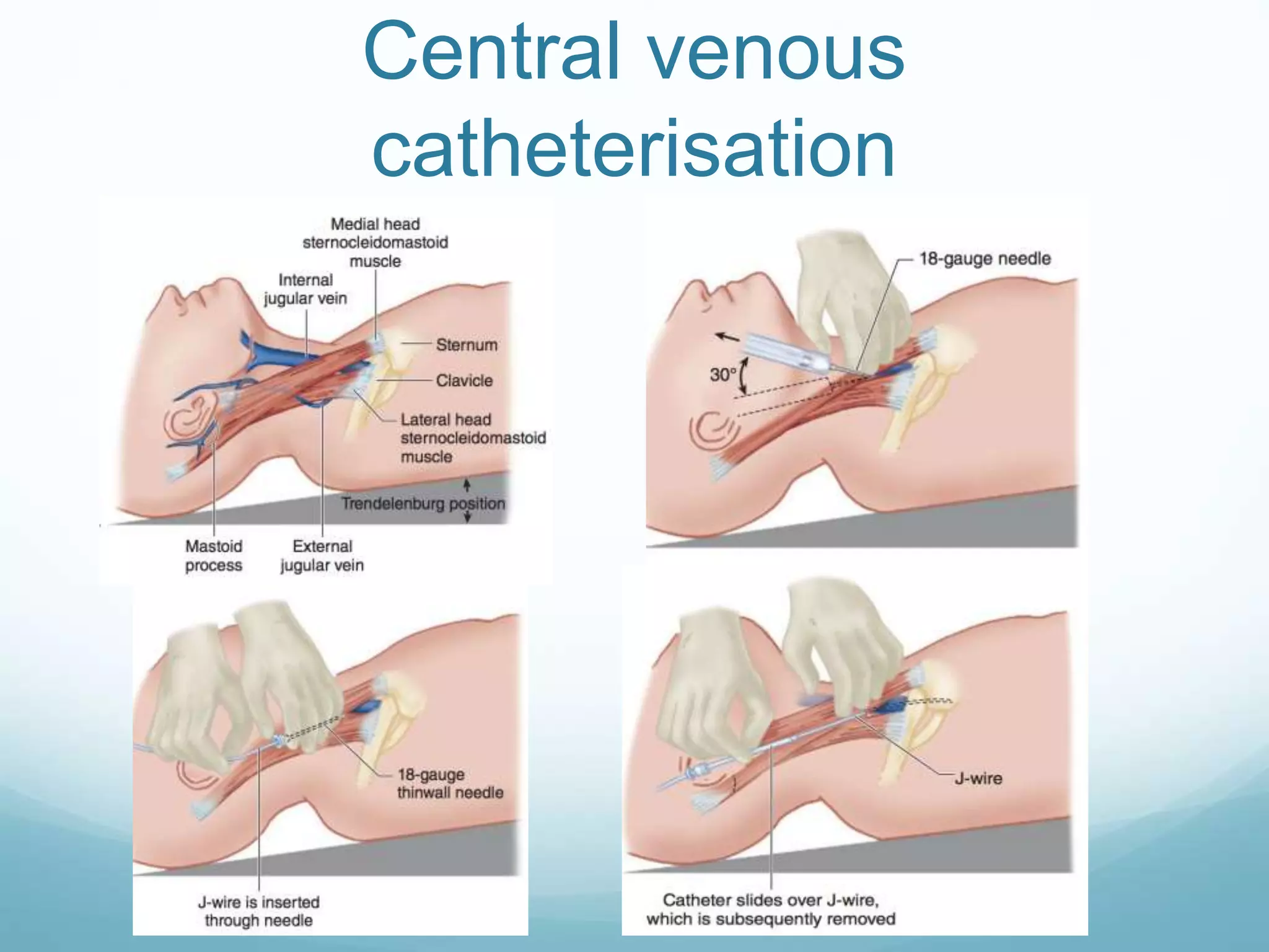 Central venous
catheterisation
 