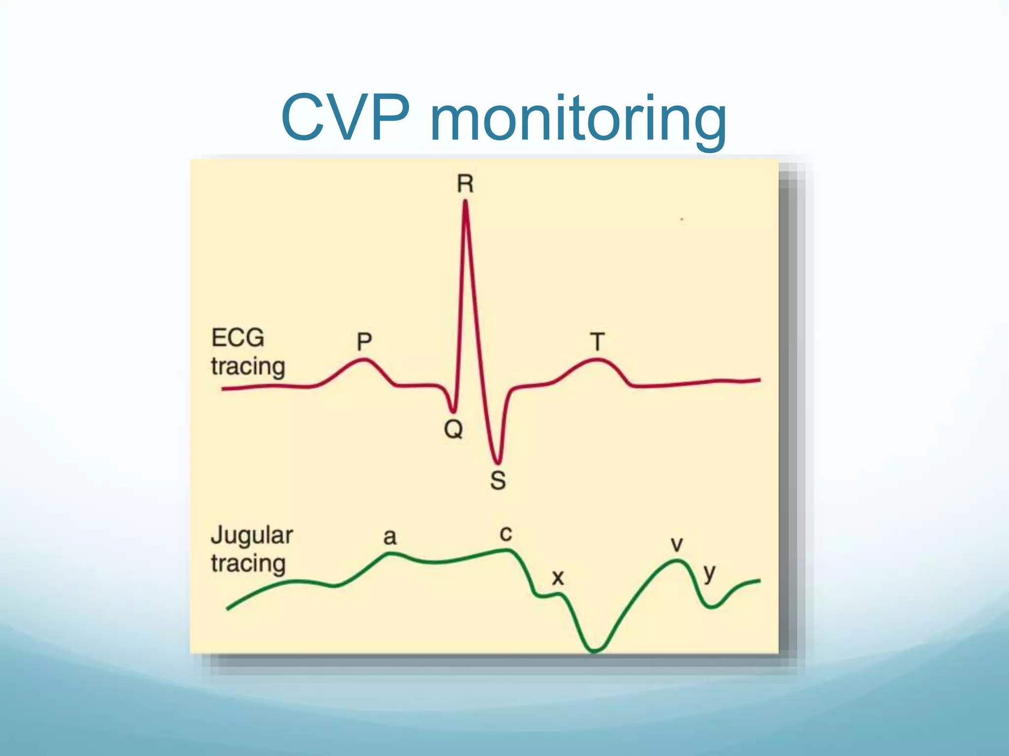 CVP monitoring
 