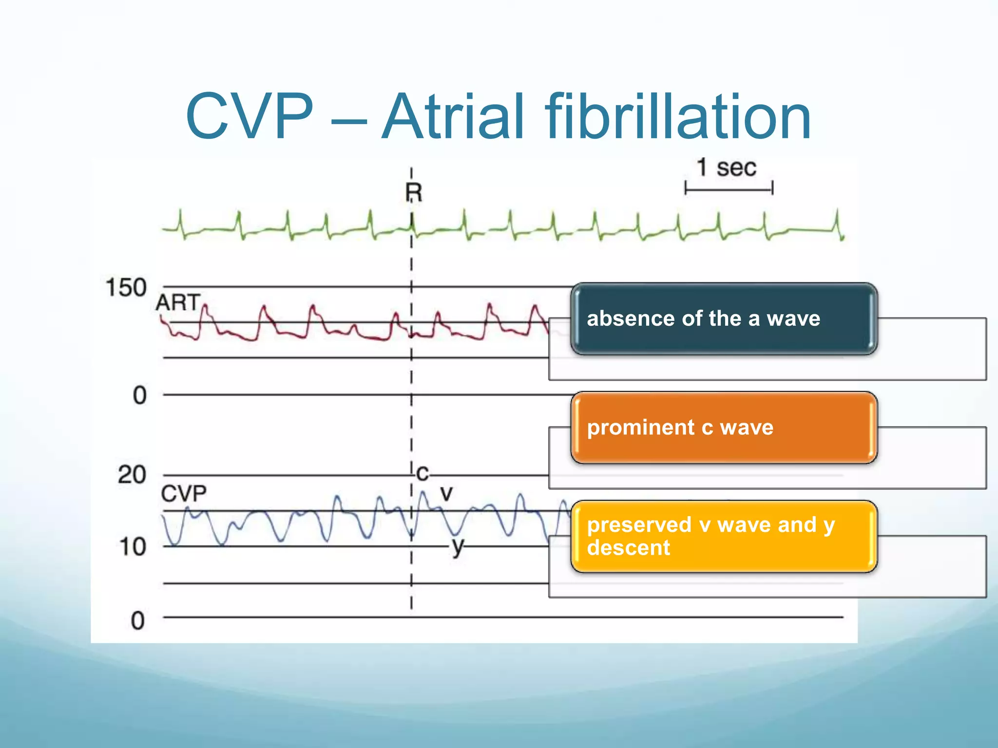 CVP – Atrial fibrillation
absence of the a wave
prominent c wave
preserved v wave and y
descent
 