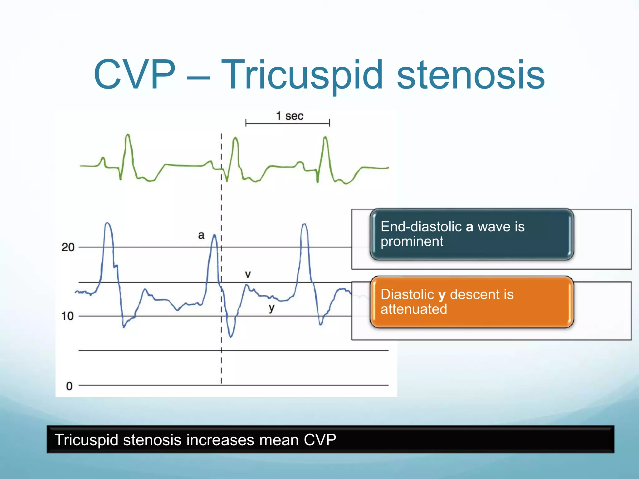 CVP – Tricuspid stenosis
End-diastolic a wave is
prominent
Diastolic y descent is
attenuated
Tricuspid stenosis increases mean CVP
 