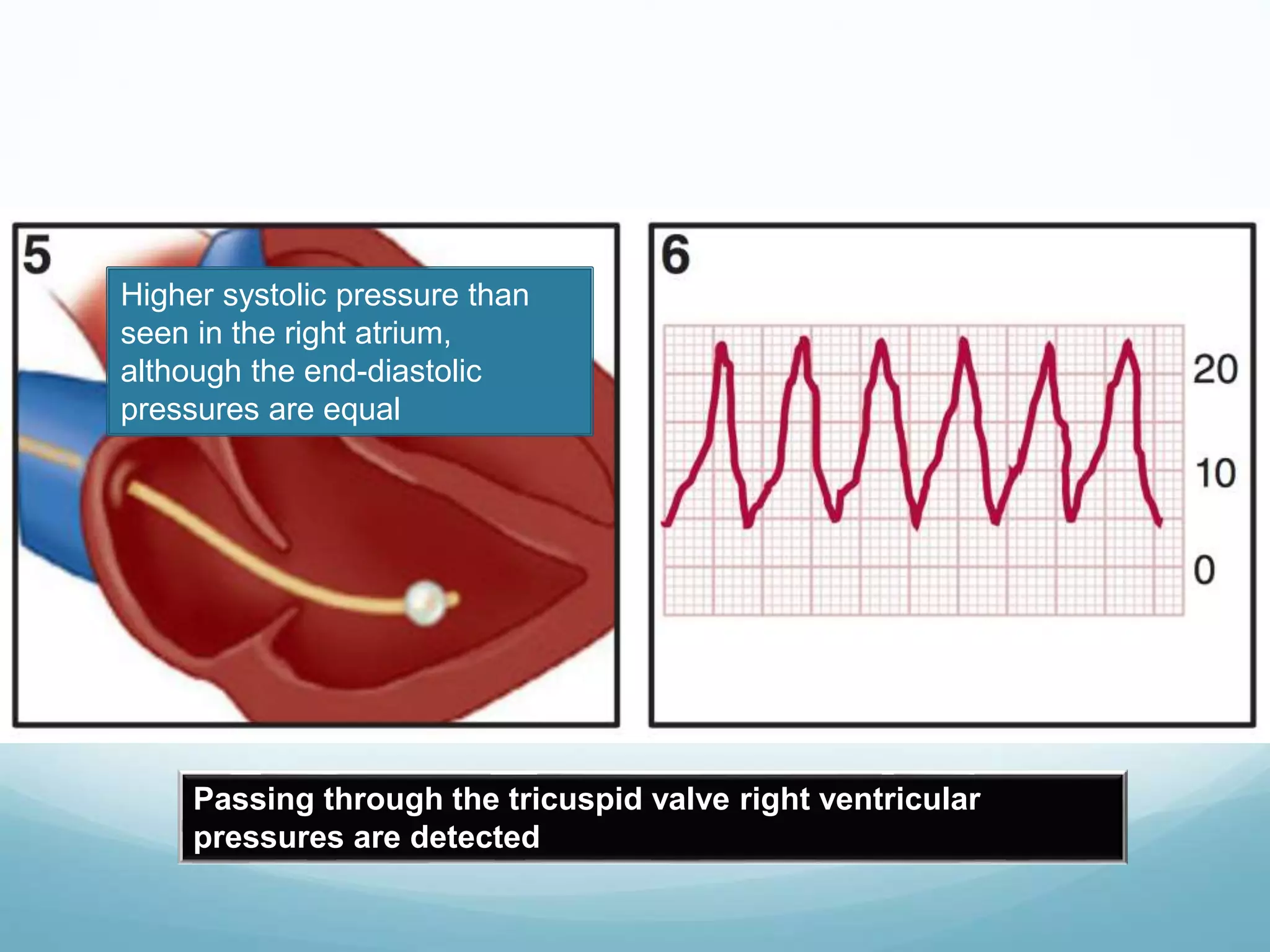 Passing through the tricuspid valve right ventricular
pressures are detected
Higher systolic pressure than
seen in the right atrium,
although the end-diastolic
pressures are equal
 