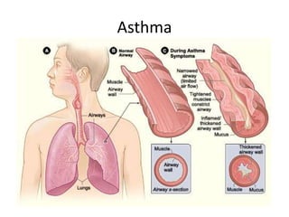 Asthma
 
