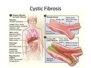 Cystic Fibrosis
 