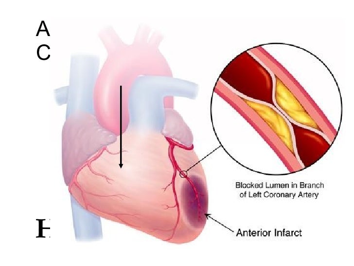 Ischemic Heart Diseases 