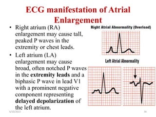 ECG manifestation of Atrial
Enlargement
• Right atrium (RA)
enlargement may cause tall,
peaked P waves in the
extremity or chest leads.
• Left atrium (LA)
enlargement may cause
broad, often notched P waves
in the extremity leads and a
biphasic P wave in lead V1
with a prominent negative
component representing
delayed depolarization of
the left atrium.
6/10/2022 36
 