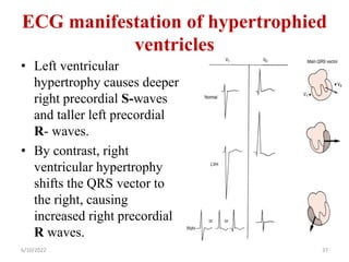 ECG manifestation of hypertrophied
ventricles
• Left ventricular
hypertrophy causes deeper
right precordial S-waves
and taller left precordial
R- waves.
• By contrast, right
ventricular hypertrophy
shifts the QRS vector to
the right, causing
increased right precordial
R waves.
6/10/2022 37
 