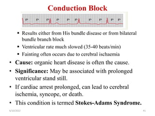 Conduction Block
 Results either from His bundle disease or from bilateral
bundle branch block
 Ventricular rate much slowed (35-40 beats/min)
 Fainting often occurs due to cerebral ischaemia
• Cause: organic heart disease is often the cause.
• Significance: May be associated with prolonged
ventricular stand still.
• If cardiac arrest prolonged, can lead to cerebral
ischemia, syncope, or death.
• This condition is termed Stokes-Adams Syndrome.
6/10/2022 41
 