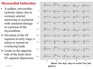 Myocardial Infarction
• A sudden, irreversible,
ischemic injury due to
coronary arterial
narrowing or occlusion
with sustained damage
to a portion of the
myocardium.
 Elevation of the ST
segment at early stage
return to normal on
overlaying leads.
 Leads on the opposite
side of the heart show
ST segment depression.
6/10/2022 52
Hours few days days to weeks Very late
pattern
 