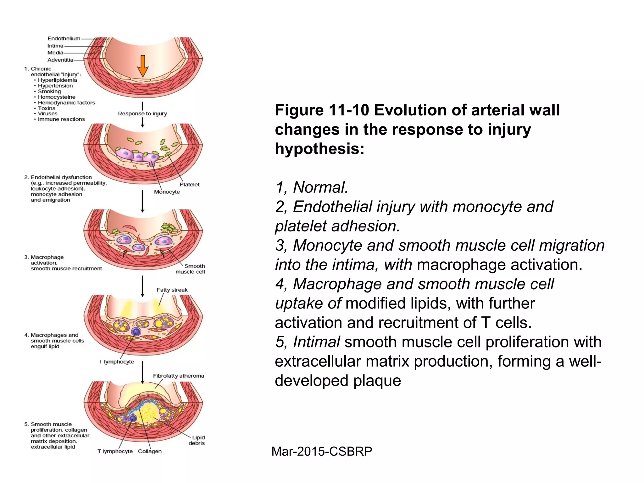 Figure 11-10 Evolution of arterial wall
changes in the response to injury
hypothesis:
1, Normal.
2, Endothelial injury with monocyte and
platelet adhesion.
3, Monocyte and smooth muscle cell migration
into the intima, with macrophage activation.
4, Macrophage and smooth muscle cell
uptake of modified lipids, with further
activation and recruitment of T cells.
5, Intimal smooth muscle cell proliferation with
extracellular matrix production, forming a well-
developed plaque
Mar-2015-CSBRP
 