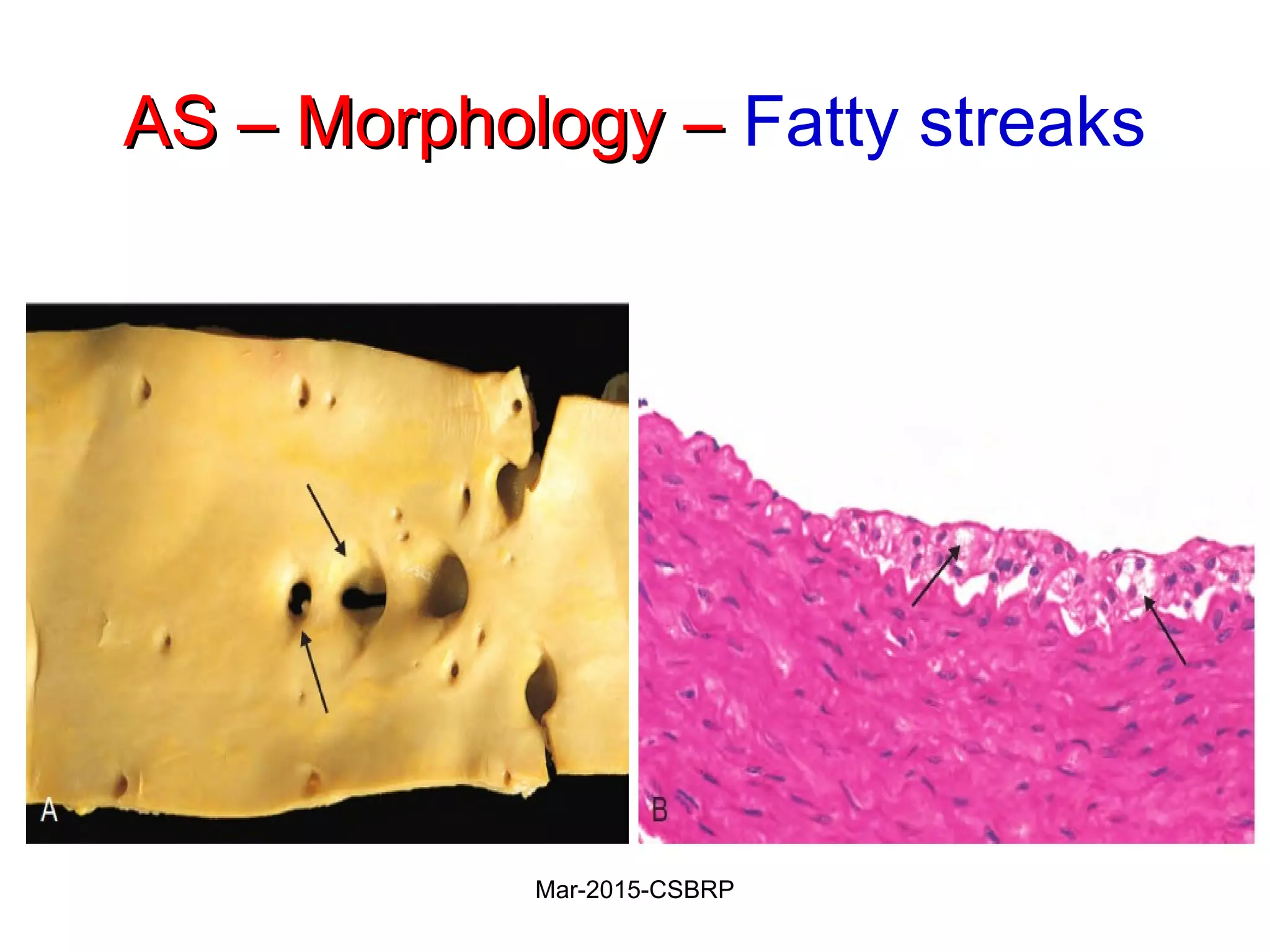 AS – Morphology –AS – Morphology – Fatty streaks
Mar-2015-CSBRP
 