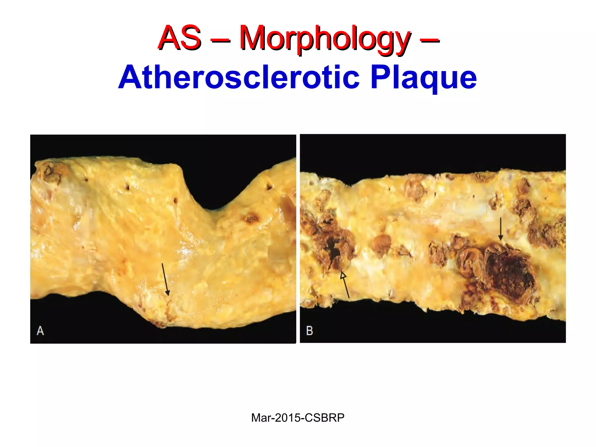 AS – Morphology –AS – Morphology –
Atherosclerotic Plaque
Mar-2015-CSBRP
 