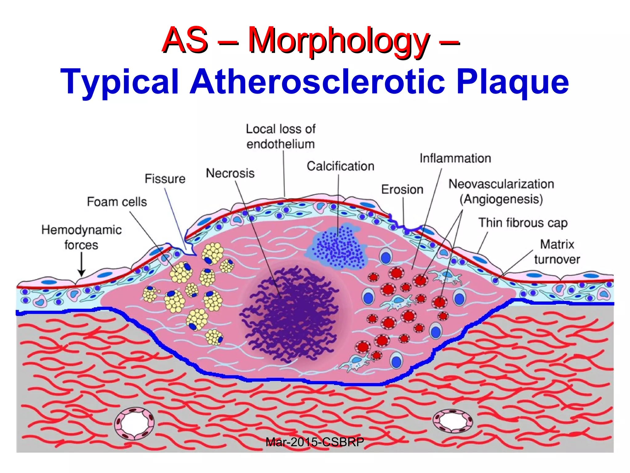 AS – Morphology –AS – Morphology –
Typical Atherosclerotic Plaque
Mar-2015-CSBRP
 
