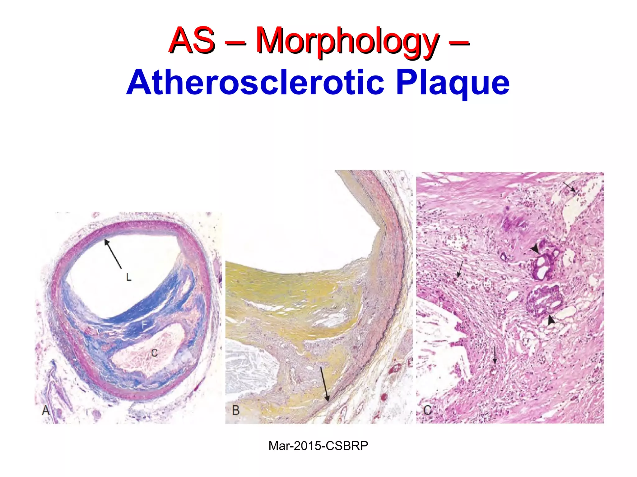 AS – Morphology –AS – Morphology –
Atherosclerotic Plaque
Mar-2015-CSBRP
 