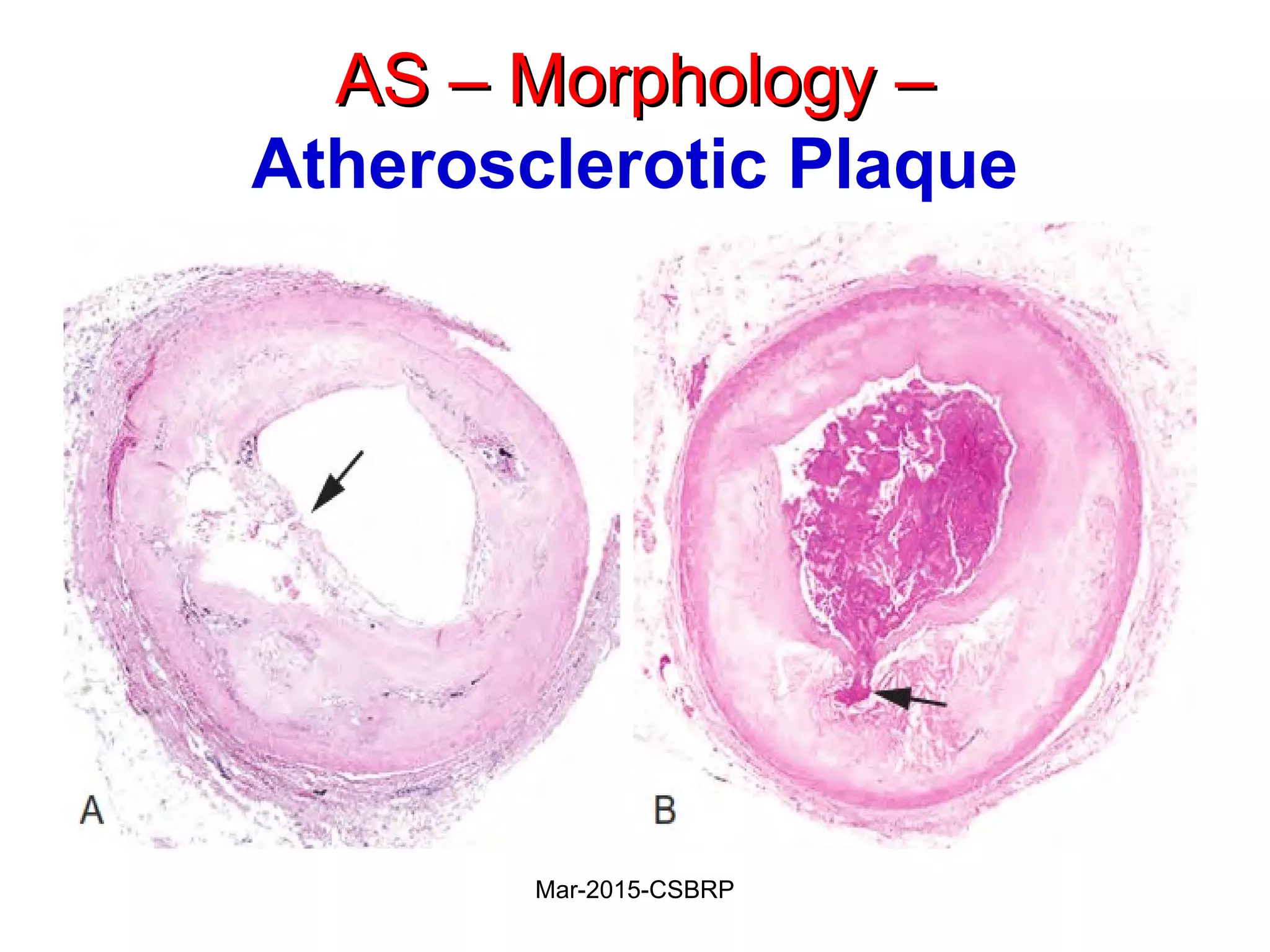 AS – Morphology –AS – Morphology –
Atherosclerotic Plaque
Mar-2015-CSBRP
 