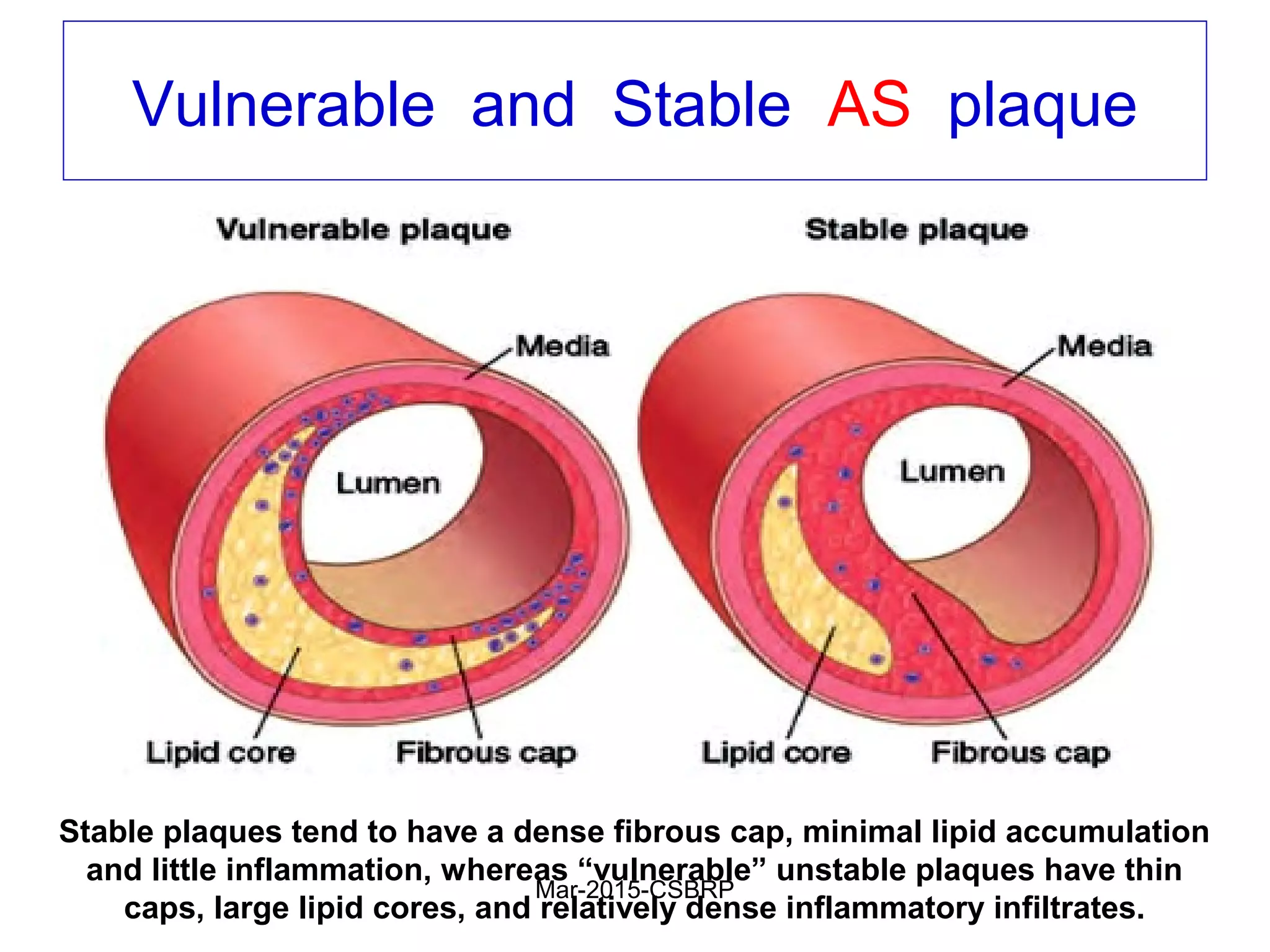 Vulnerable and Stable AS plaque
Stable plaques tend to have a dense fibrous cap, minimal lipid accumulation
and little inflammation, whereas “vulnerable” unstable plaques have thin
caps, large lipid cores, and relatively dense inflammatory infiltrates.
Mar-2015-CSBRP
 