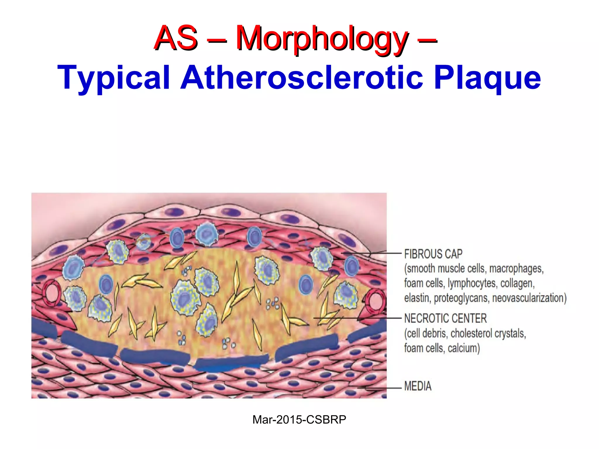 AS – Morphology –AS – Morphology –
Typical Atherosclerotic Plaque
Mar-2015-CSBRP
 