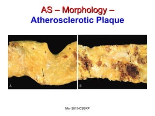 AS – Morphology –AS – Morphology –
Atherosclerotic Plaque
Mar-2015-CSBRP
 