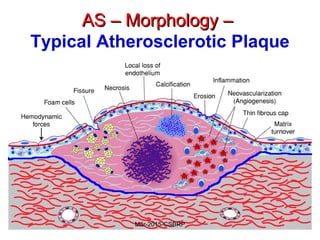 AS – Morphology –AS – Morphology –
Typical Atherosclerotic Plaque
Mar-2015-CSBRP
 