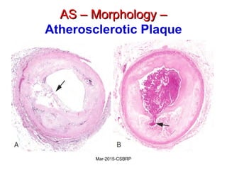AS – Morphology –AS – Morphology –
Atherosclerotic Plaque
Mar-2015-CSBRP
 