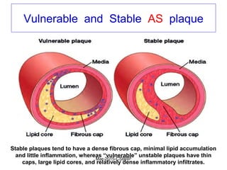 Vulnerable and Stable AS plaque
Stable plaques tend to have a dense fibrous cap, minimal lipid accumulation
and little inflammation, whereas “vulnerable” unstable plaques have thin
caps, large lipid cores, and relatively dense inflammatory infiltrates.
Mar-2015-CSBRP
 