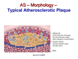 AS – Morphology –AS – Morphology –
Typical Atherosclerotic Plaque
Mar-2015-CSBRP
 